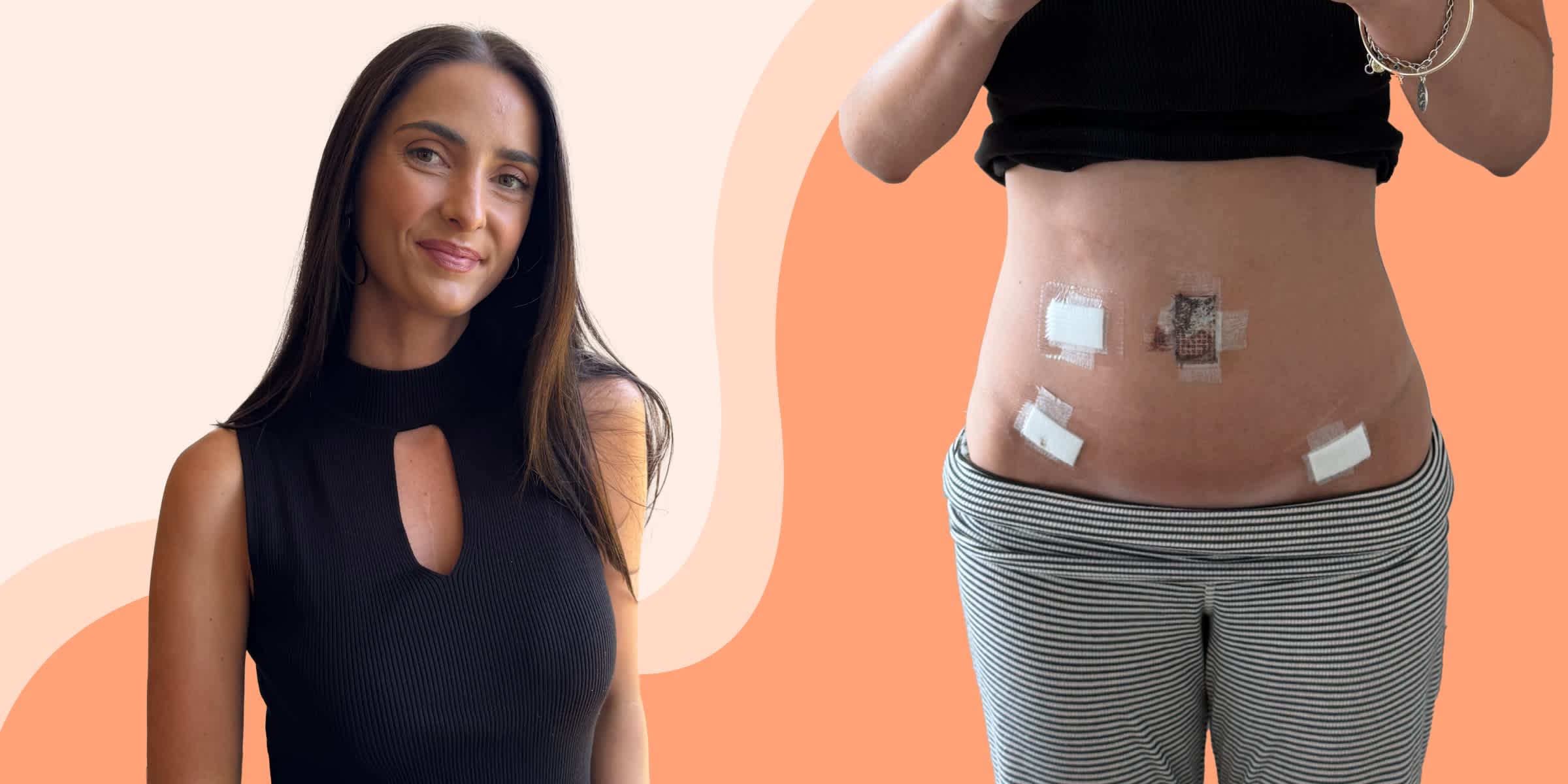 Headshot of Lisa and a picture of her stomach with bandages