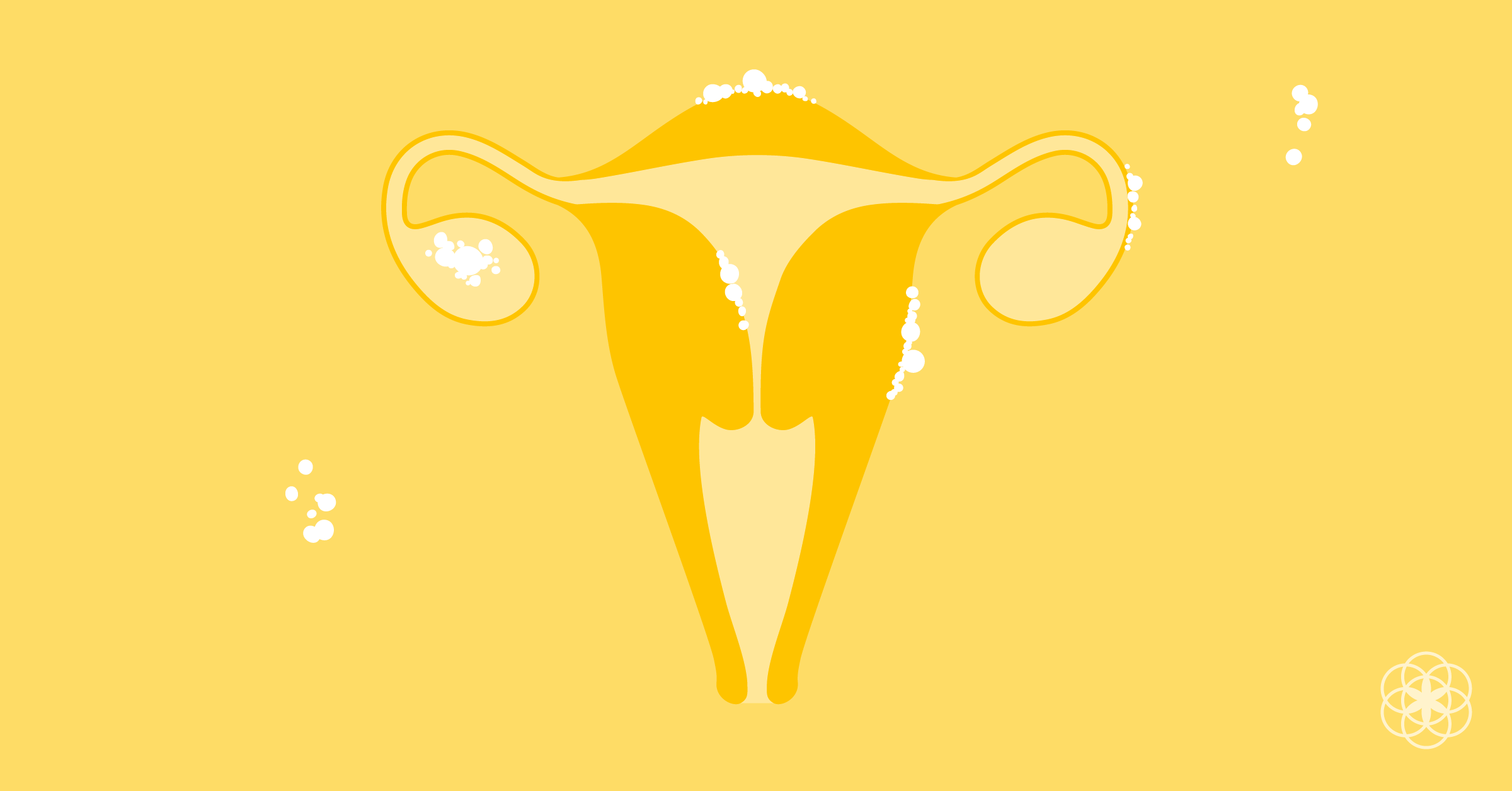 Endometriosis Causas Sintomas Diagnosticos Y Tratamientos