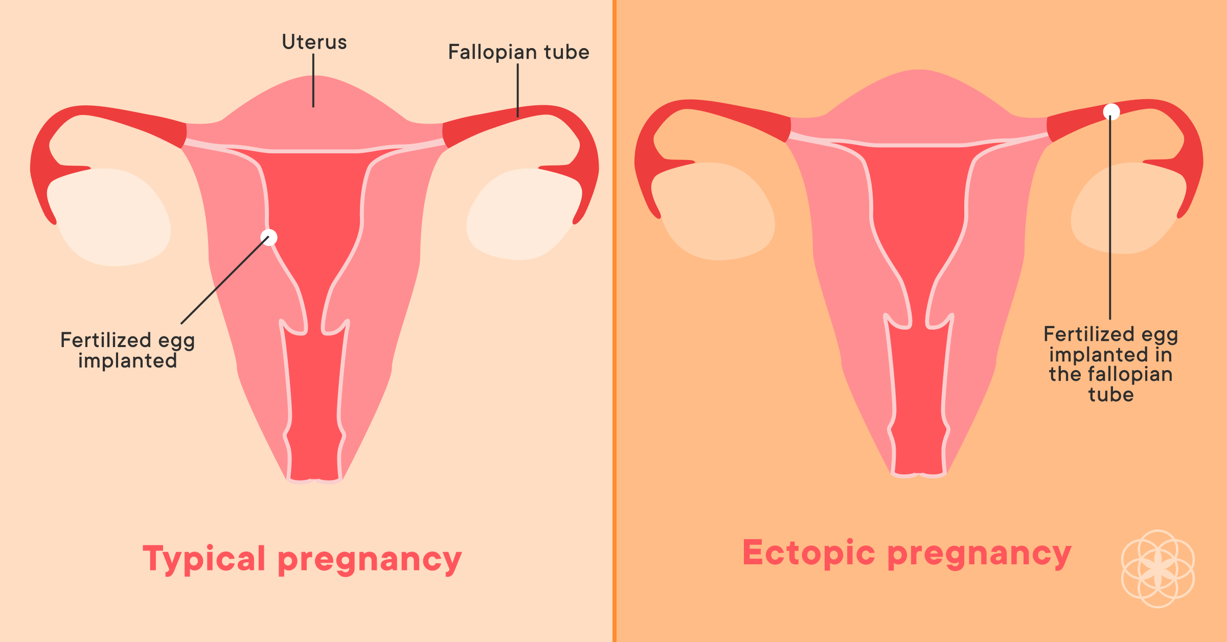 Ectopic pregnancy is rare. Here's what you need to know.