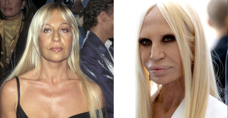 Donatella Versace Before and After Plastic Surgery - Vanity