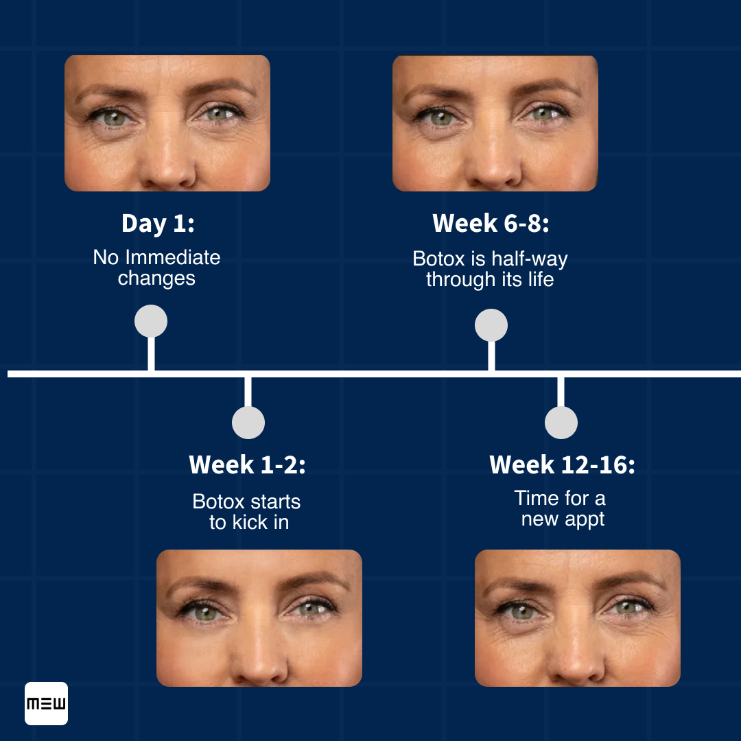 Botox timeline