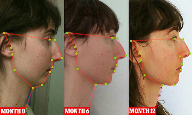 Mewing Before and After with Dr. Mew