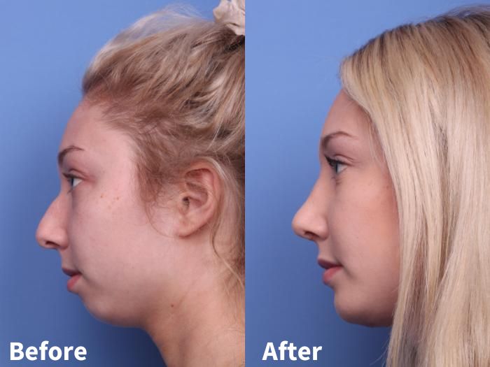 Before and after images of chin surgery 