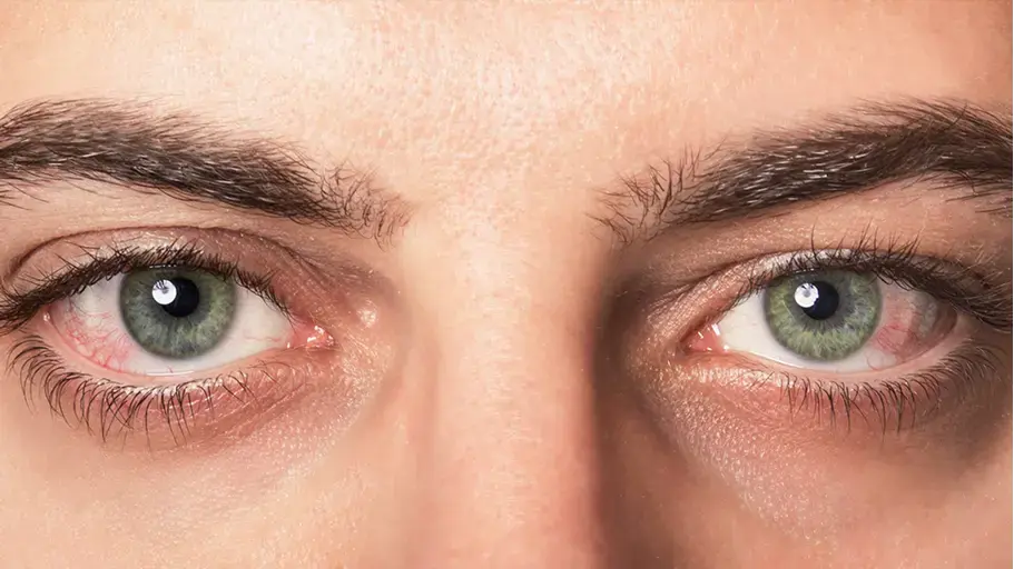 A closeup of a person with green eyes experiencing redness
