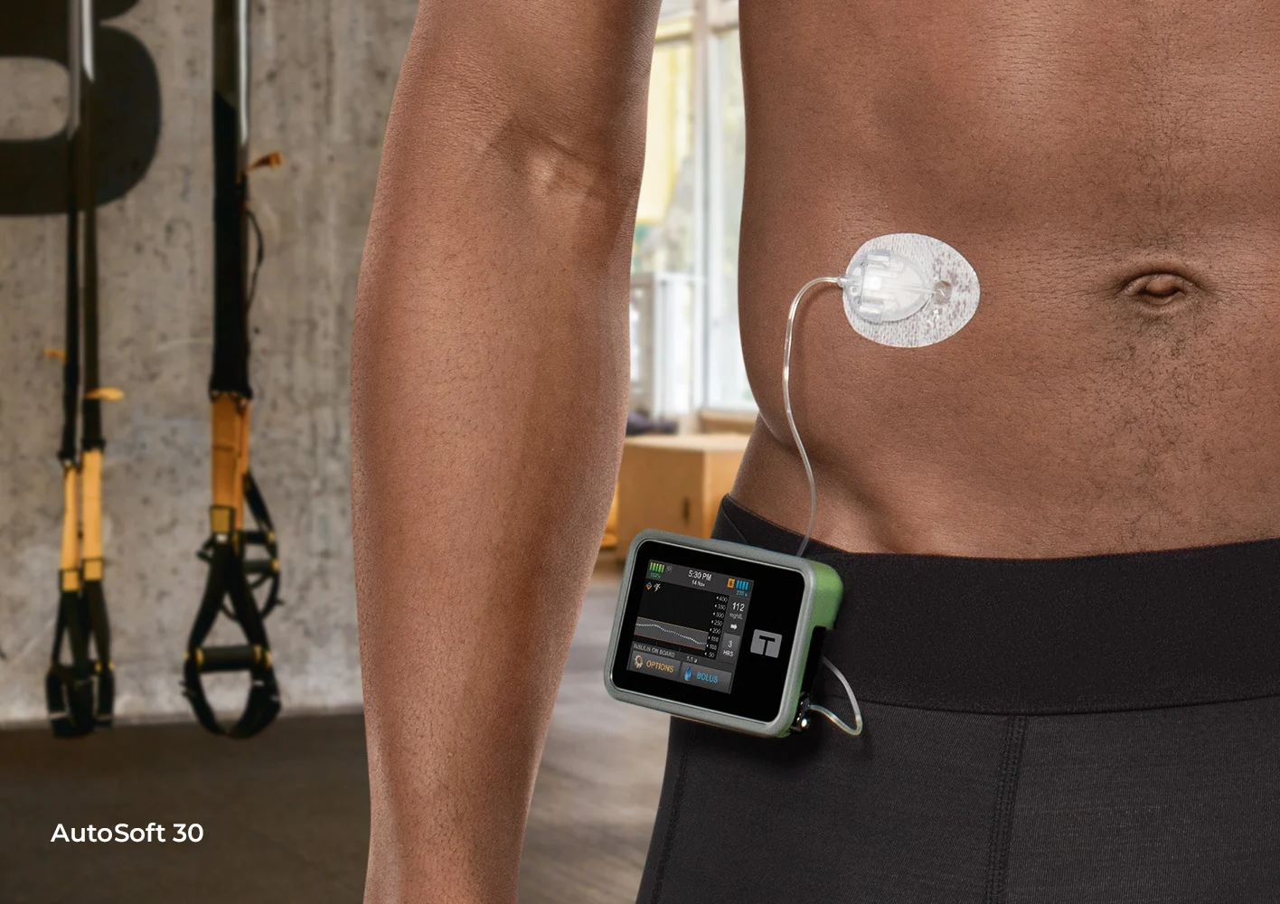 Tandem pump user, Mide, wearing the AutoSoft 30 infusion set