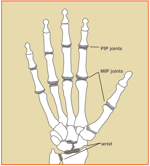 Ra Rp Nodes Finger Nodes In Rheumatoid Arthritis