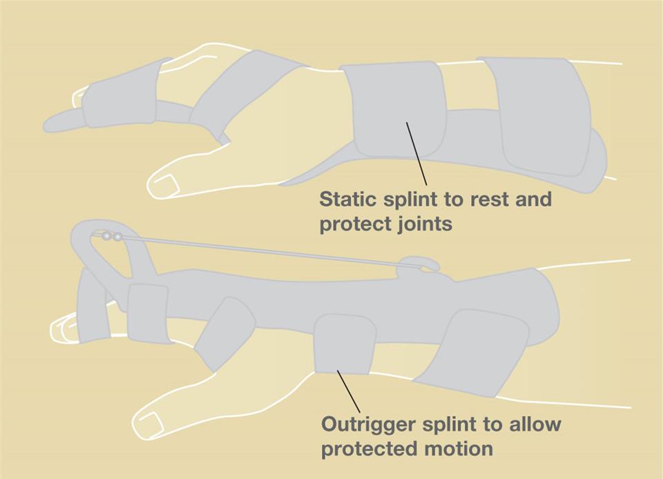 Knuckle Types