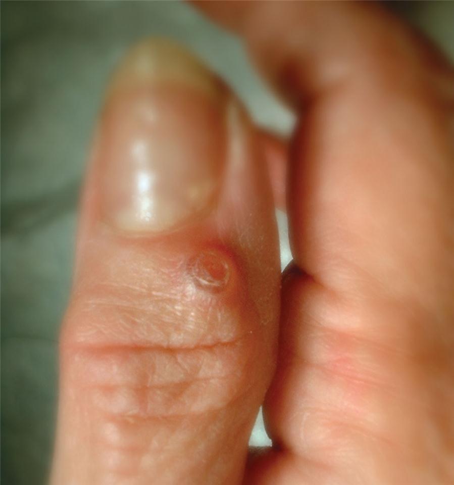 Ganglion Cysts: What is? Symptoms, Causes, & Treatment | The Hand Society