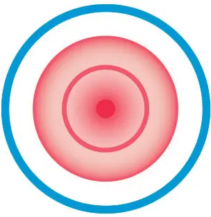 Diaper Rash Cause: Irritation