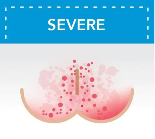 Severe Diaper Rash