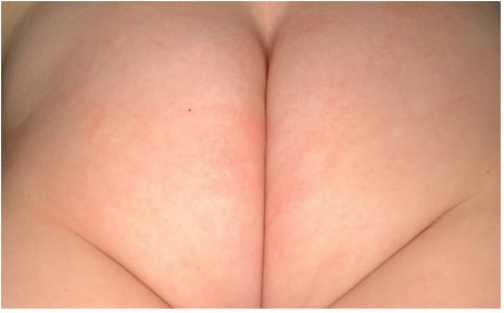 Mild Diaper Rash Picture with Papules