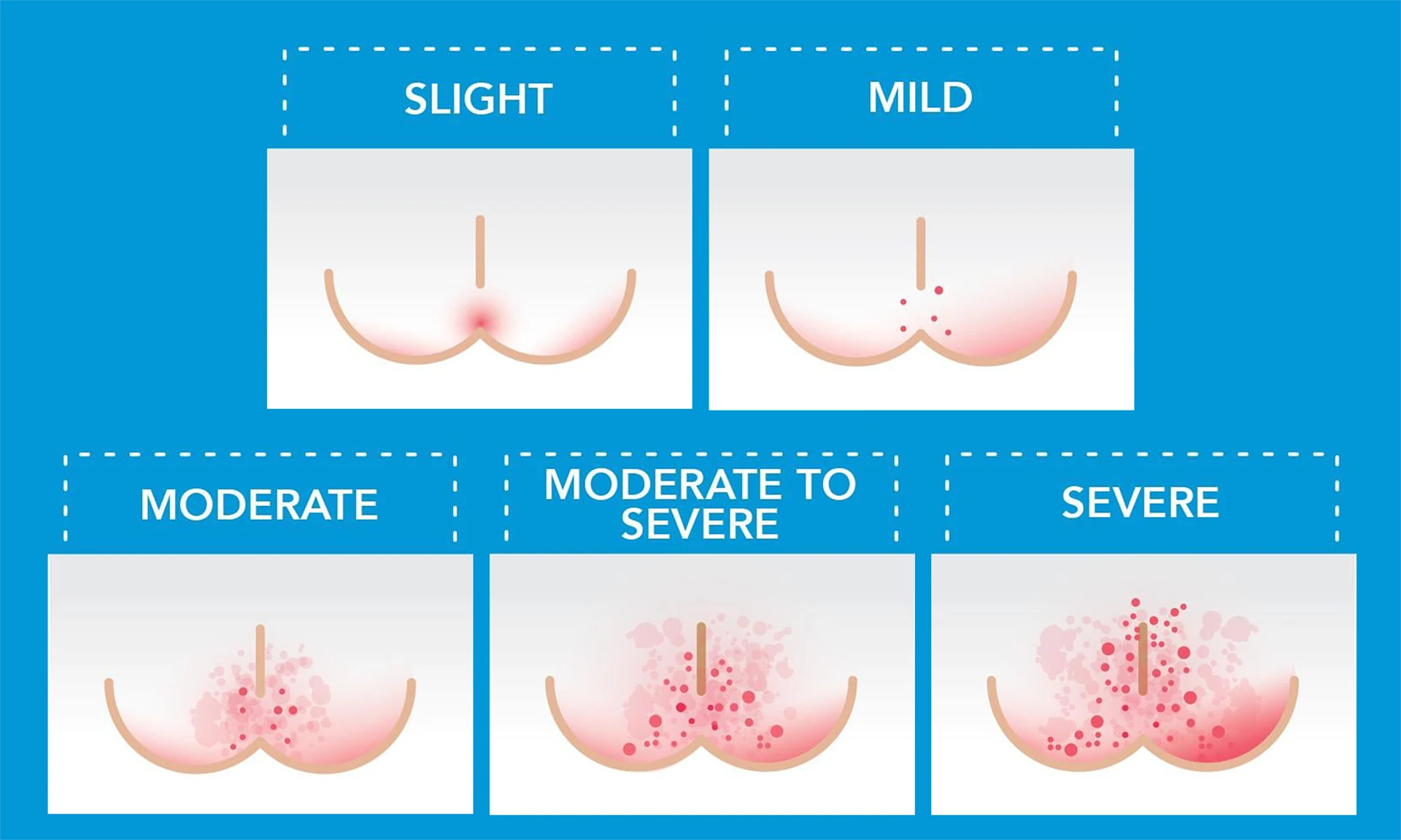 Illustration of diaper rash's progression from slight to severe. Slight: shows minimal redness, mild has small spots, moderate has increased redness and spots, moderate to severe shows more spreading, and severe displays extensive redness and irritation.