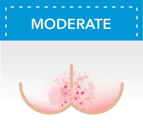 Moderate Diaper Rash