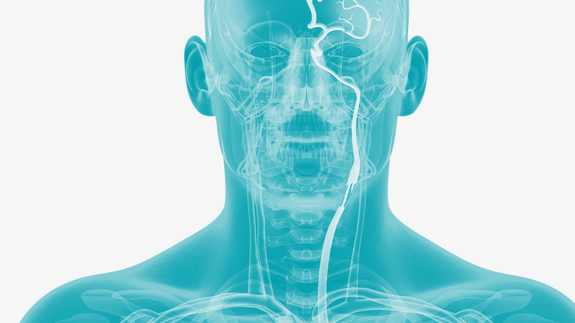 Ischemic