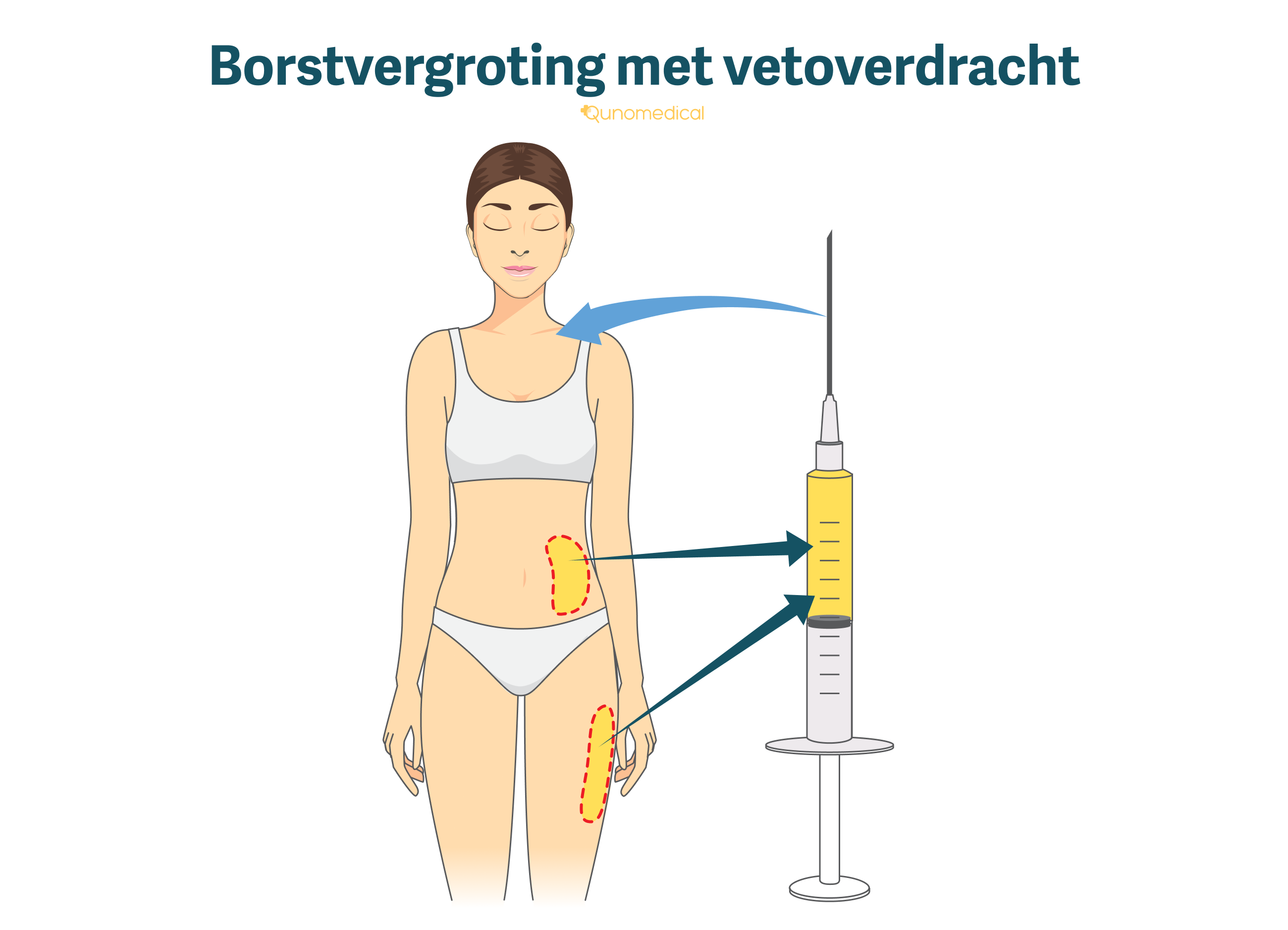 Lipofilling Van Borsten | Qunomedical