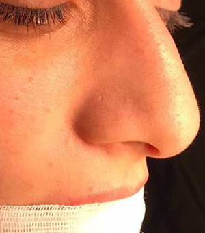 nose job turkey all inclusive