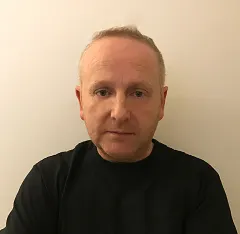 Image1_Eamon’s Hair Transplant Journey - Part I: Before Treatment