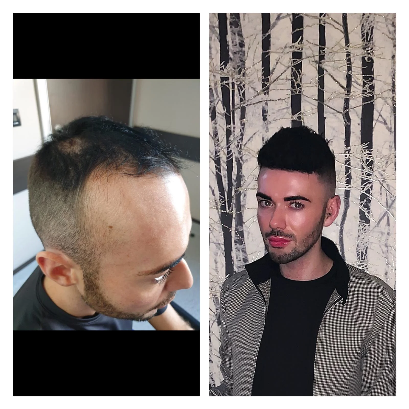 Patient Interviews: Iwan's Hair Transplant in Turkey | Qunomedical