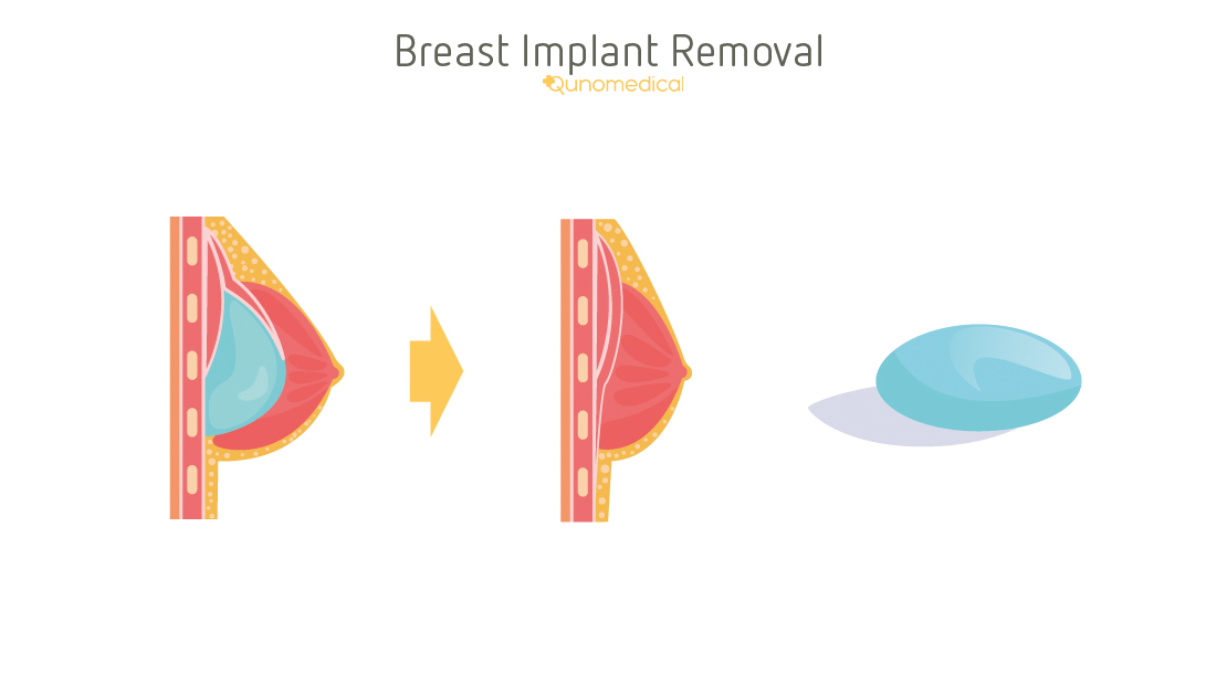 File:Diagram of an inflatable breast implant cruk 403.svg