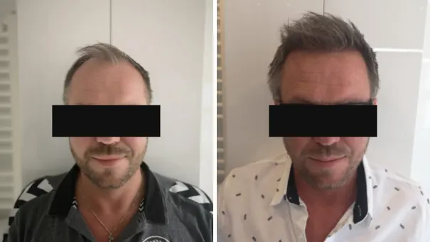Man showing hair before and after undergoing a sapphire FUE hair transplant.