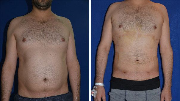 Man standing showing his abdomen before and after undergoing liposuction for men.