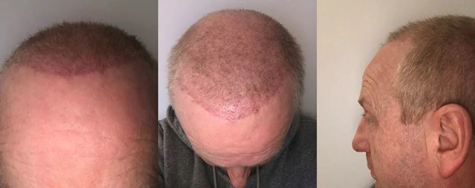 Image1_Eamon’s Hair Transplant Journey - Part III: After Treatment