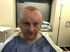 Image5_Eamon’s Hair Transplant Journey - Part II: During Treatment
