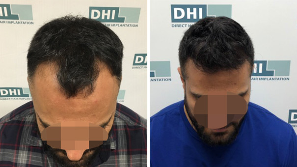 Mann zeigt seine Haare vor und nach einer DHI Haartransplantation.