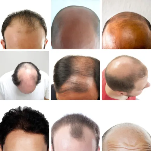 Full Hair Transplants and Complete Coverage | Qunomedical
