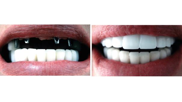 Woman showing her teeth before and after having all-on-4 dental implants fitted.