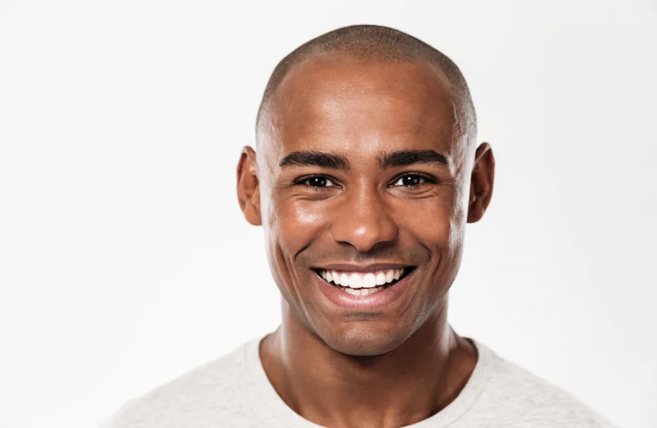 Trasplantes de pelo y pelo afro: opciones de cirugía
