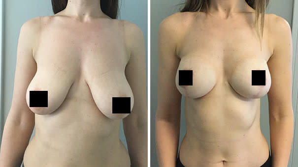 Woman showing breasts before and after undergoing breast lift surgery.