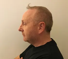 Image5_Eamon’s Hair Transplant Journey - Part I: Before Treatment