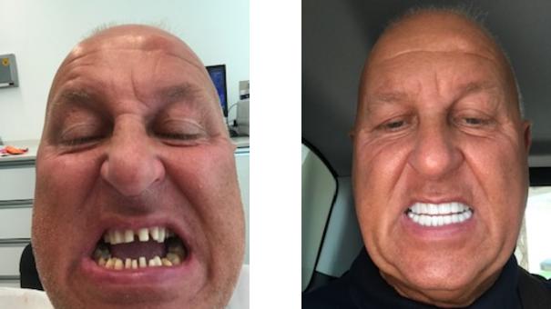 Patient zeigt seine Zähne vor und nach einer Behandlung mit Veneers.