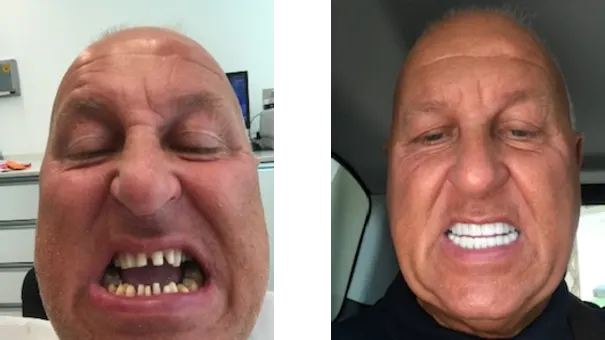 Patient zeigt seine Zähne vor und nach einer Behandlung mit Veneers.