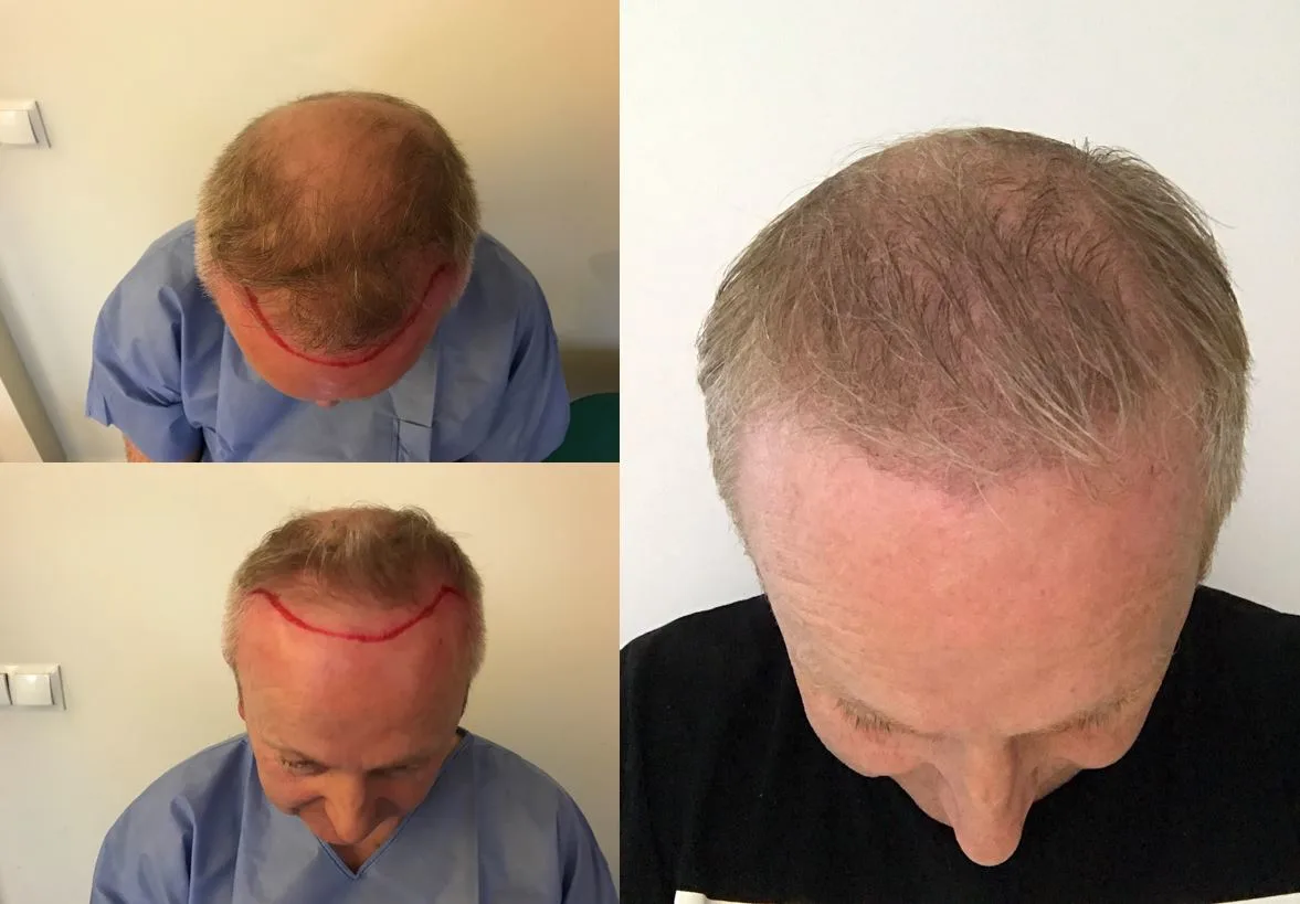 Patient Stories: Eamon's Hair Transplant 3 Months Later | Qunomedical