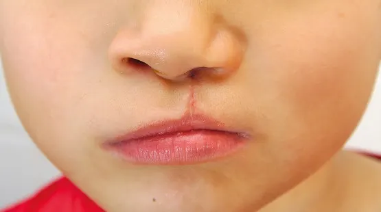 cleft lip pic