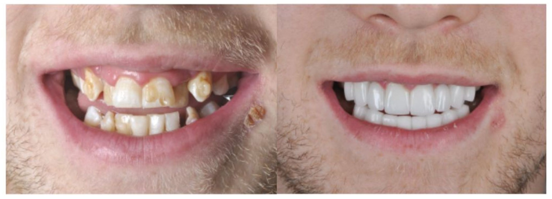 crooked teeth before and after veneers