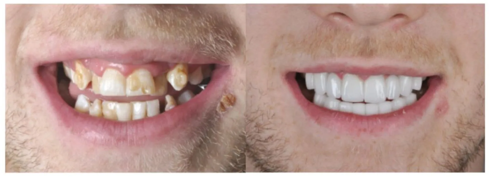 Patient showing teeth before and after having dental veneers fitted.
