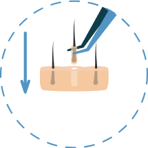 Illustration showing the fourth step of the FUE hair transplant procedure.