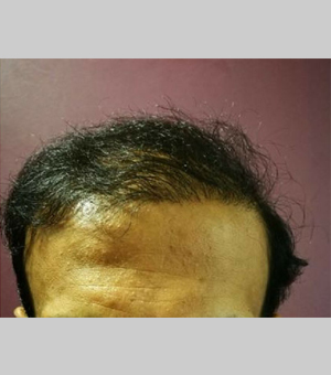 FUE Hair Transplant - in the UK & Abroad | Qunomedical