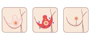 Diagram showing procedure of breast reduction treatments.