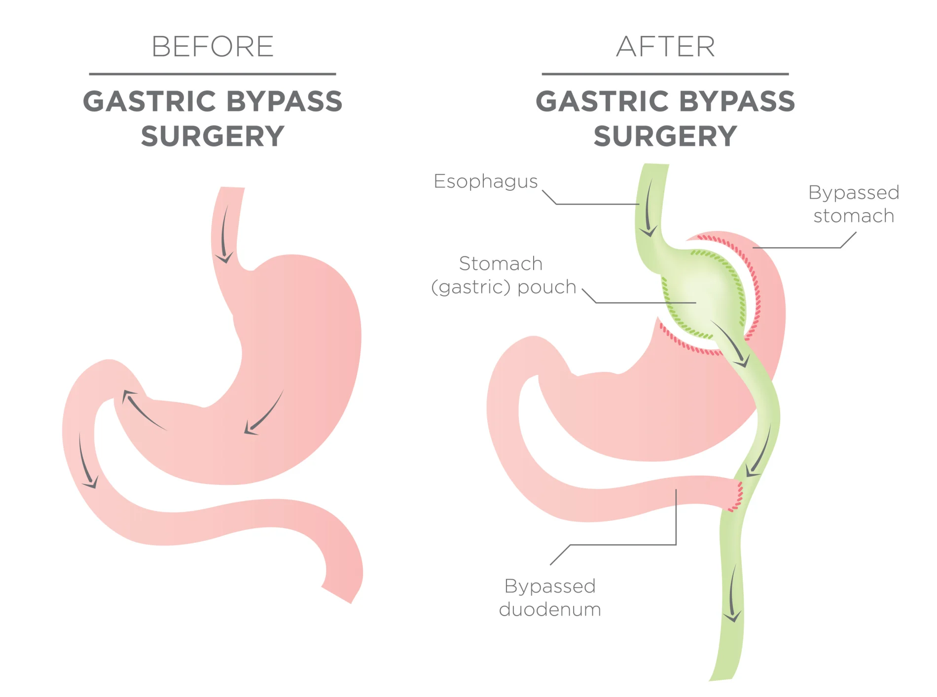 EN image 2 for Bariatric Surgery Cost Guide