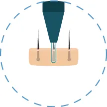 Ilustración mostrando el primer paso del procedimiento de trasplante de cabello FUE.