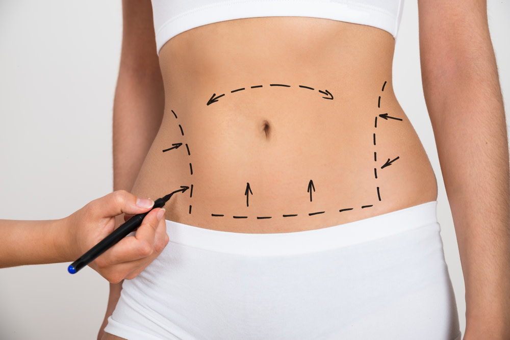 Überschüssige haut am bauch