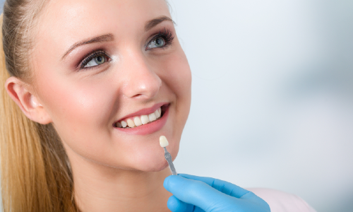 Patiente souriant et montrant ses dents avant et après la pose de facettes dentaires. 