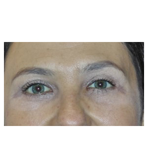Eyelid surgery in Montreal | Dr Sandra McGill