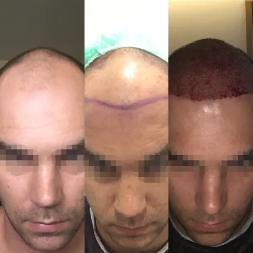 Image1_Patient Stories: Charles’s Hair Transplant - 5 Months Later