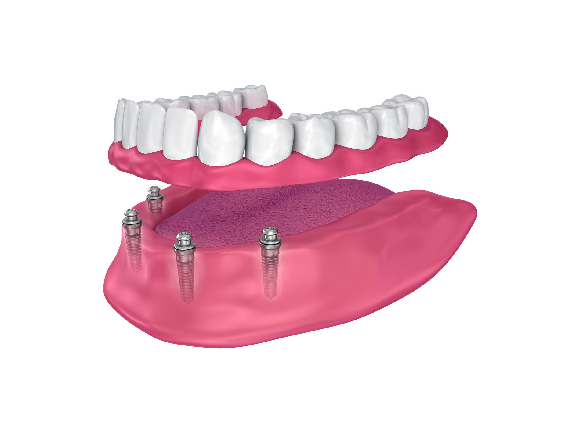 3D image of all-on-4 dental implants.