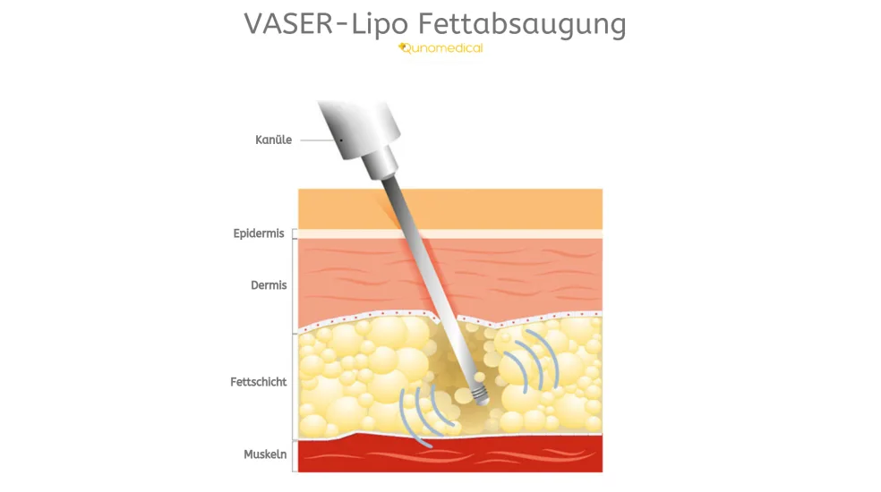 Illustration, die zeigt, wie ein VASER-Lipo Fettabsaugung funktioniert.